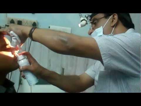 Saline Nasal Spray For Nasal allergy