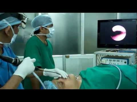 Sedated Sleep Endoscopy before Snoring and OSA Surgery