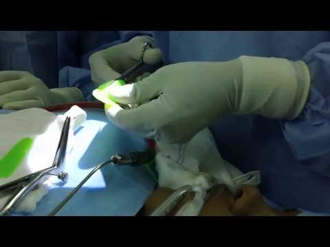 Septal Spur Removal and RF Turbinoplasty for Sluders Neuralgis