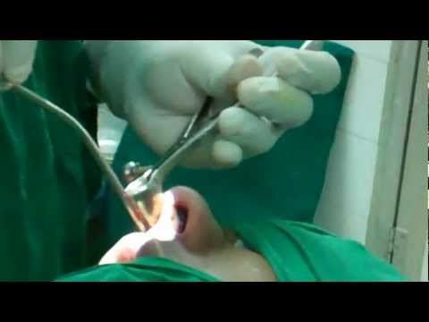 Septo Rhinoplasty:Septoplasty First