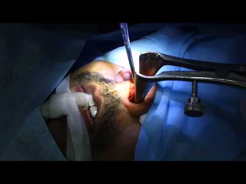 Septoplasty and Turbinoplasty by Co2Laser
