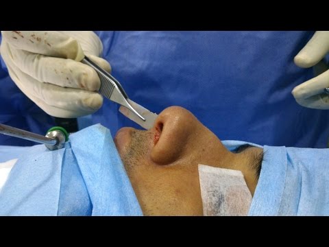 Septoplasty by Reimplanting Cartilage