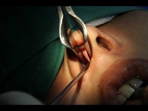 Septoplasty Can Cause Nasal Collapse