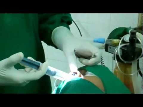 Septoplasty:Final Packing and Suturing