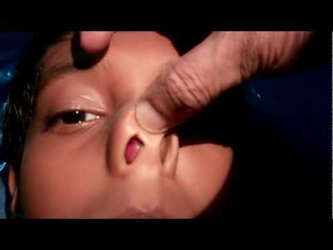 Septoplasty in Children?