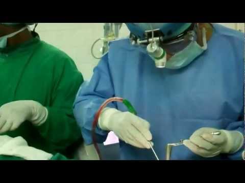 Septoplasty Operation