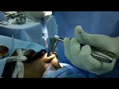 Septoplasty Operation-Endoscopic Evaluation