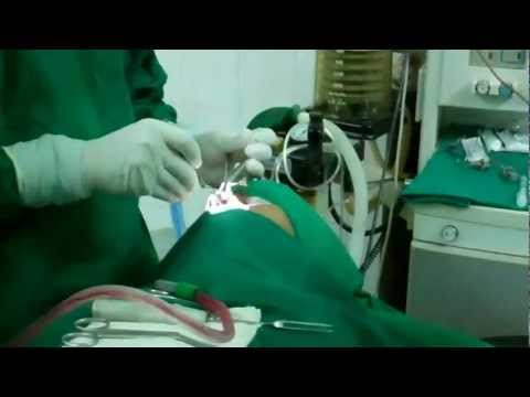 Septoplasty Operation :How it is done?