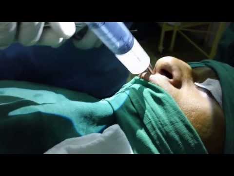 Septoplasty plus Rhinoplasty in Trivandrum South India