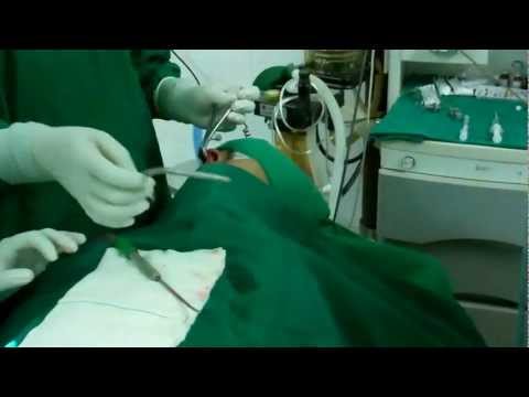 Septoplasty:Septal Reconstruction Operation