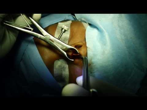 Septoplasty Using Septal Cartilage Implant