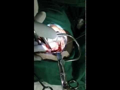 Severe Sleep Apnea Case :UPPP Surgery Revisited