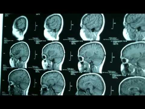 Severe Snoring and Sleep Apnea in Children:MRI Imaging