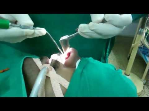 Sinus Sinuplasty:Simple way