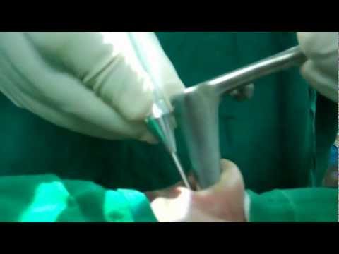 Sinus Surgey- Antrostomy using Co2 Laser