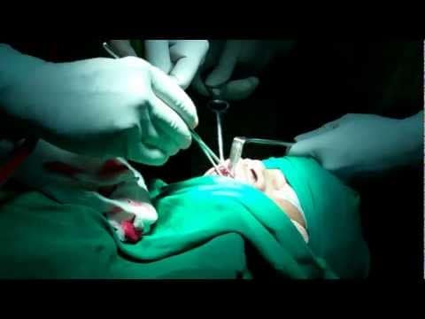 Sinusitis:Caldwel luc and FESS combined