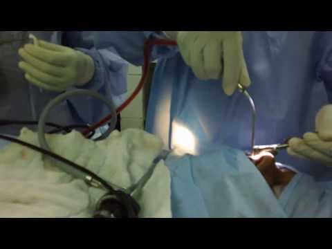 Sinusitis Surgery Using Microdebrider in Trivandrum India