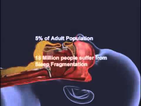 Sleep Apnea and CPAP.flv