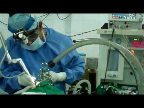 Sleep Apnea:Laser Surgery