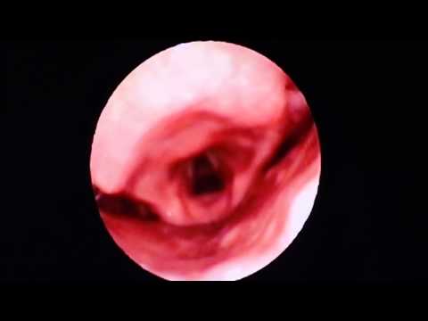 Sleep Apnea:Sleep Endoscopy before OSA Surgery