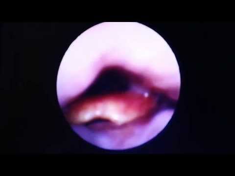 Sleep Apnea:Somnoendoscopy vs Dynamic MRI