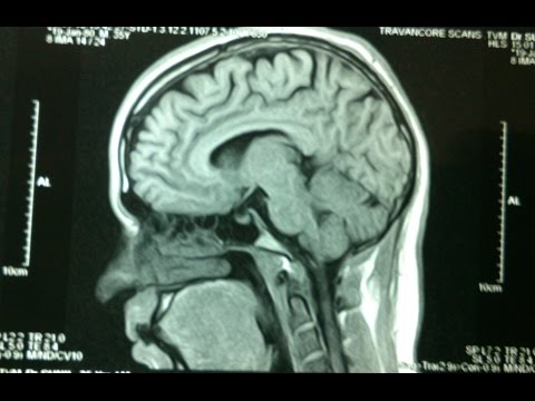 Sleep Apnea-Vit D, Melatonin and Biological Clock
