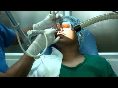 Sneezing Cure by Laser