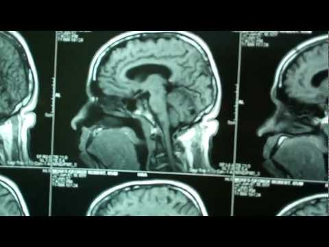 Snoring and OSA:Investigations before Surgery