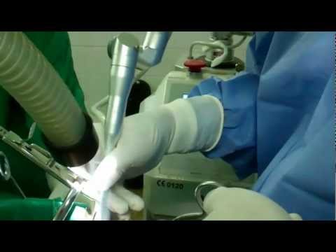 Snoring and OSA : Laser Surgery