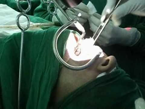 Snoring and OSA-Laser Surgery of Throat.AVI