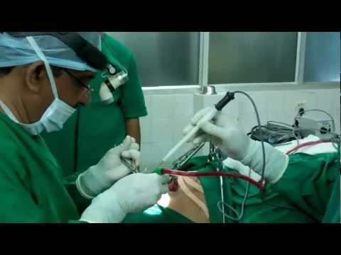 Snoring and OSA:Nasal Surgery