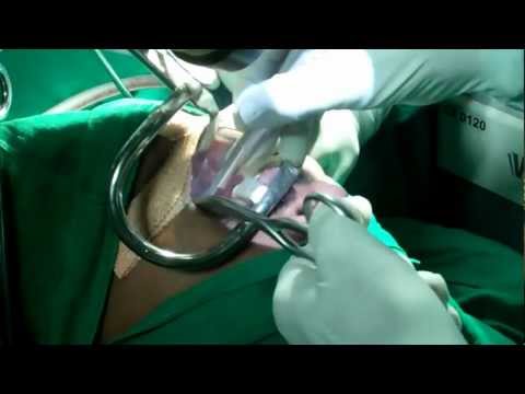 Snoring And OSA Surgery: By Laser- How It is Done?