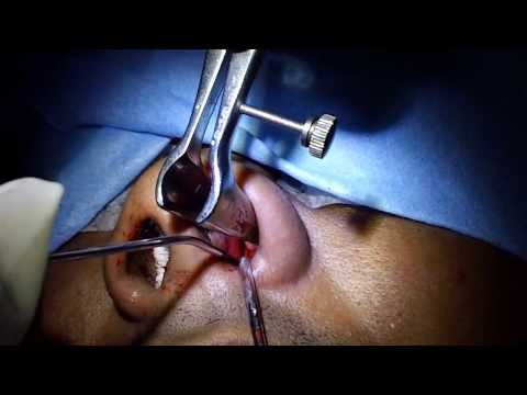 Snoring and Sleep Apnea:A New Generation Disease