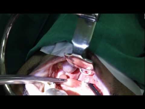 Snoring and Sleep Apnea Can Cause Depression