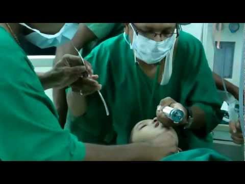 Snoring and Sleep apnea in Children:Tonsillectomy;GA-Intubation