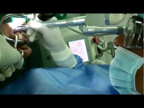 Snoring and Sleep Apnea : Laser Surgery