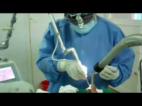 Snoring and Sleep Apnea-Laser Surgery of Nose_LAPT and LAS