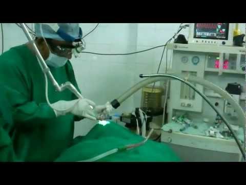 Snoring and Sleep Apnea:Laser Turbinate Reduction-LAPT.