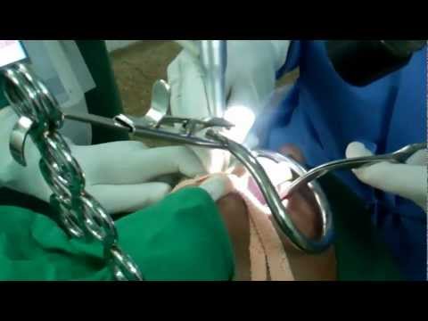 Snoring and Sleep apnea: LAUP