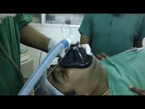 Snoring and Sleep Apnea Surgery in India- Intubation