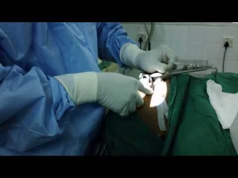 Snoring and Sleep Apnea Surgery: Not Easy