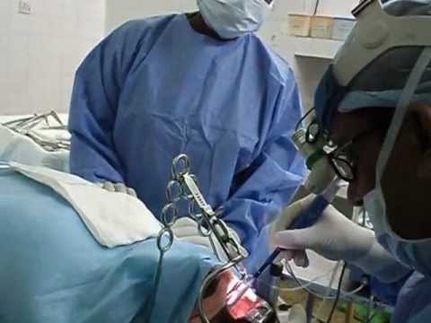 Snoring And Sleep Apnea Surgery