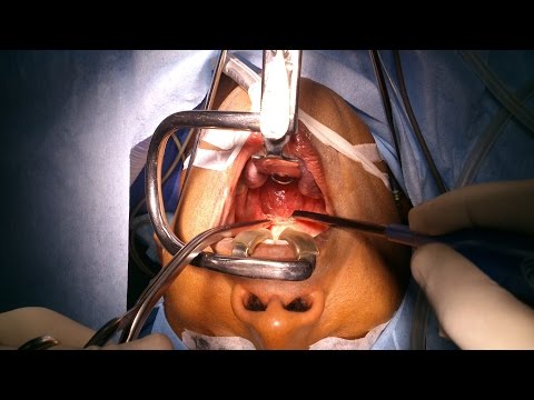 Snoring and Sleep Apnea-Treatment