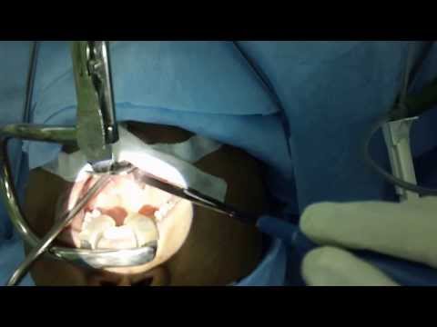 Snoring and Sleep Apneain Women:Surgery or CPAP?