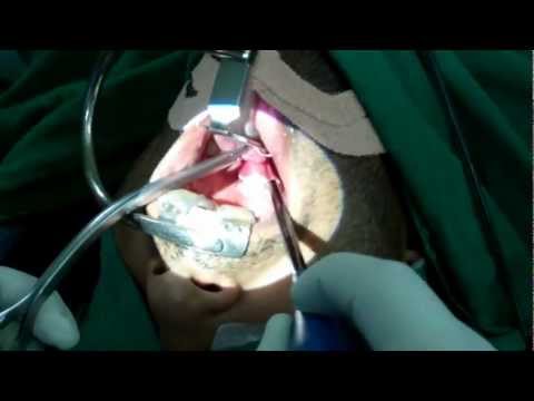 Snoring and Sleep Surgery in India:Medical Tourism