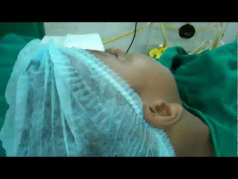 Snoring and Stoppage Breathing in Children:Sleep Apnea