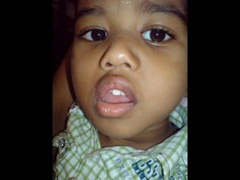 Snoring Child – Adenoids and Dental Malocclusion