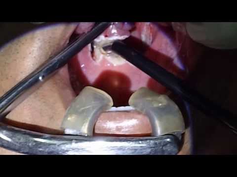 Snoring-CPAP Or Surgery:Which One is Best?