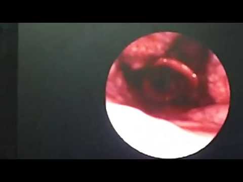 Snoring from Pharyngeal Obstruction