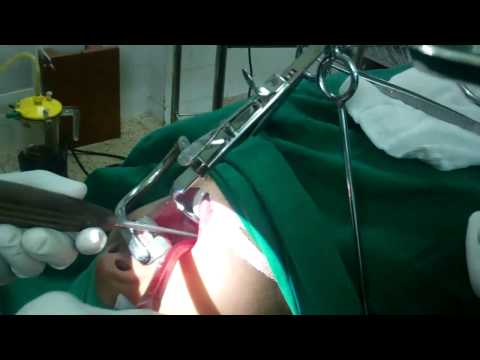 Snoring in Children due to Very Large Adenoid:Adenoid Removal Traitional Method